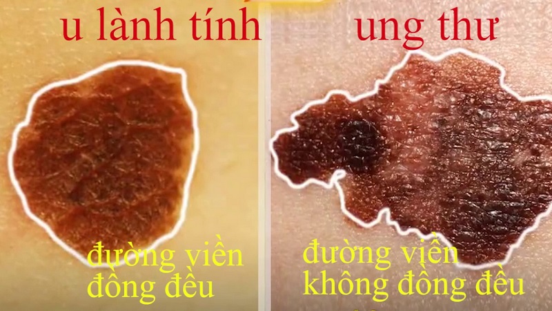 Hình thái ung thư nốt ruồi